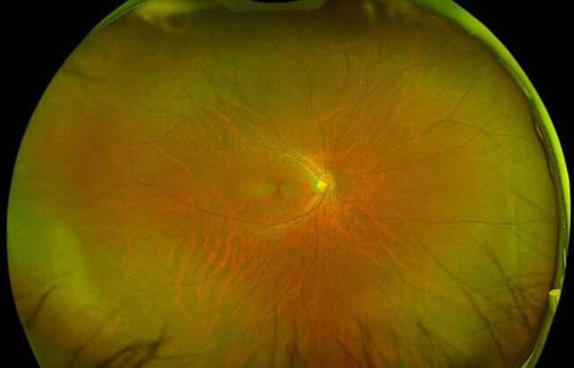 広角眼底カメラで撮影された正常な目の眼底写真。中央から広がる血管と視神経乳頭が映っている。