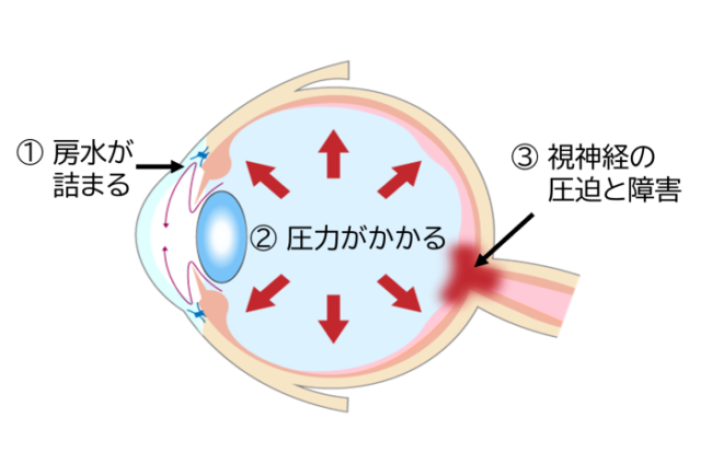 緑内障の発症メカニズムを描いた眼球の図解イラスト。「①房水が詰まる」「②圧力がかかる」「③視神経の圧迫と障害」の3つのステップが矢印で順に示されている。